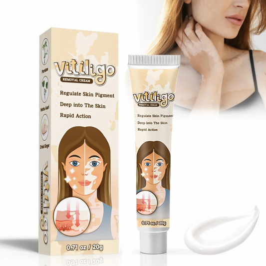 الكريم السحري لإزالة البهاق